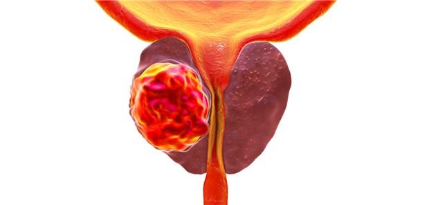 Prostata-Ca: Innerhalb von zehn Jahren nach externer Radiatio erkrankten 2,25 Prozent der Patienten an Blasenkrebs.