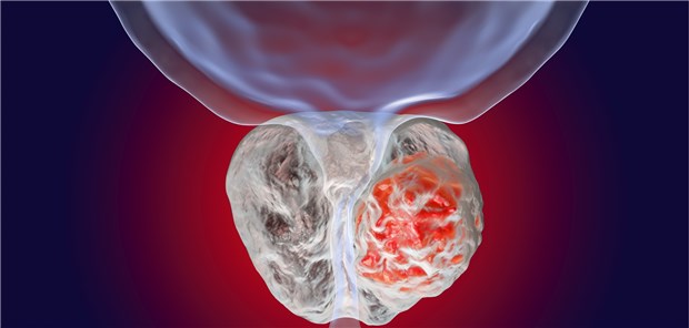 Prostata-Ca: Jetzt wurde der Nutzen von Enzalutamid/Testosteron-Suppression bei metastasiertem, hormonsensitivem Ca geprüft.
