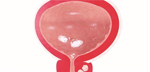Prostata-Ca: Mit MRT-Untersuchungen könnten sich Biopsien vermeiden lassen.