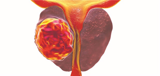 Prostata-Ca: Was leistet die mpMRT-Diagnostik?