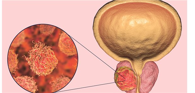 Prostata-Ca: Weiterhin der am häufigsten diagnostizierte urologische Tumor.