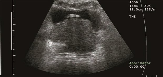 Prostata-Ca im Ultraschall. Bei fortgeschrittenen Stadien gilt die antiandrogene Therapie als Mittel der Wahl.