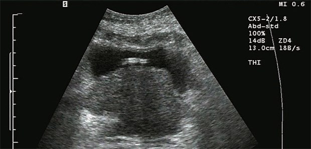 Auffälliger Geneffekt in jungen Jahren Prostata-Ca im Ultraschall. Junge Männer haben signifikant mehr genetische Varianten als ältere.
