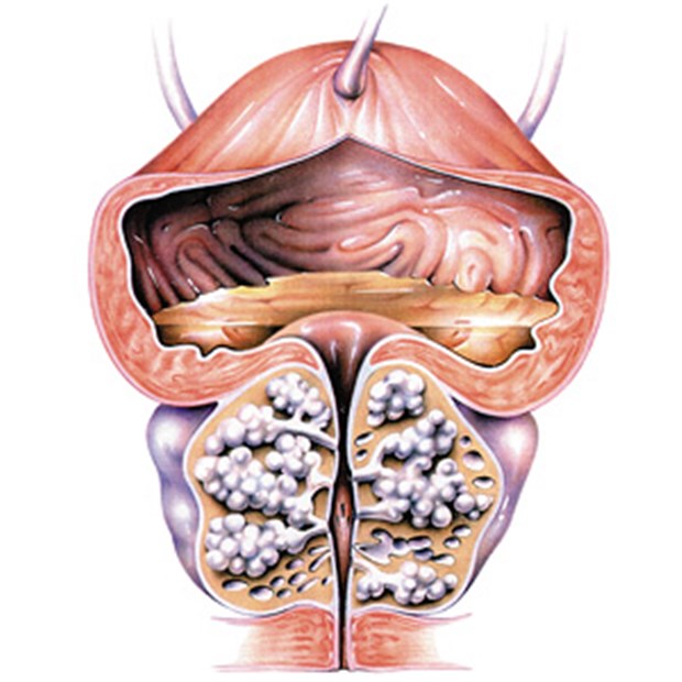 Complex de ierburi în prostată