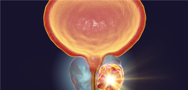 Prostata-Karzinom: Zur Therapieintensivierung bei dieser Krebsform und zu neuen systemischen Medikamenten gibt es aktualisierte Empfehlungen der europäischen Onkologie-Fachgesellschaft ESMO.