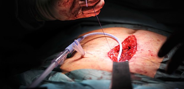 Sofortige Op bringt keinen Vorteil Prostata-Op: Schneller oder später Eingriff?
