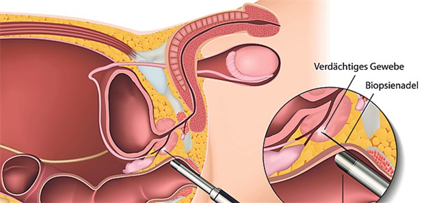 Noutăți în tratarea cancerului de prostată | Digi24