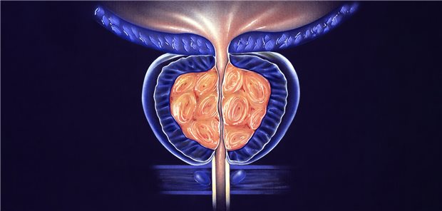Prostatahyperplasie: Hier komprimiert die Prostata die Urethra.