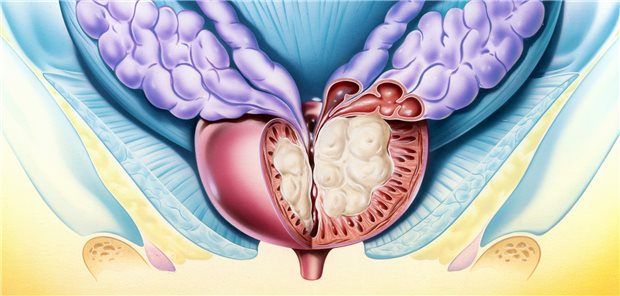 Prostatahyperplasie und damit assoziierte Symptome: Auch die Prostataarterienembolisation ist eine Therapieoption.&#xA;