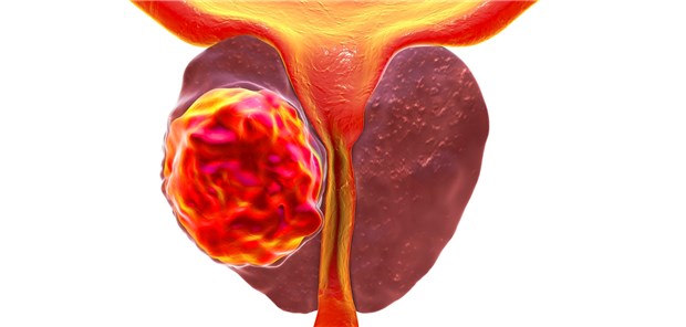 Prostatakarzinom: Auch davon betroffene Patienten haben ein deutlich erhöhtes Risiko, an einer kardiovaskulären Erkrankung zu sterben.