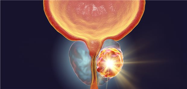 Prostatakarzinom: Ein für die Synthese von Cholesterin essenzielles Enzym könnte Ansatz für eine neue Behandlungsoption bei Patienten mit Prostatakarzinom sein.