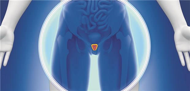 Prostatakrebs bei jungen Männern immer früher entdeckt Prostatakarzinom: In einer Studie wurde bei 65,5 Prozent der Männer unter 50 Jahren der Krebs bereits im Stadium 1 entdeckt.