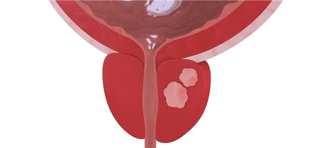Prostatakarzinom: Low-Dose-Rate-Brachytherapie ist eine Möglichkeit der Behandlung. Jetzt haben Forscherinnen und Forscher Langzeitdaten zu dieser Methode veröffentlicht.
