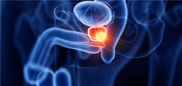 Prostatakarzinom: Über den Einsatz der fokalen Therapie beim Prostata-Ca herrscht weiter Uneinigkeit. Gebraucht wird letztlich eine differenziertere Risikoabschätzung als bislang.