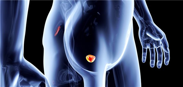 Prostatakarzinome: Die Zwölf-Stanzen-Biopsie bietet im Vergleich zu den Alternativen immer noch mehr Sicherheit.