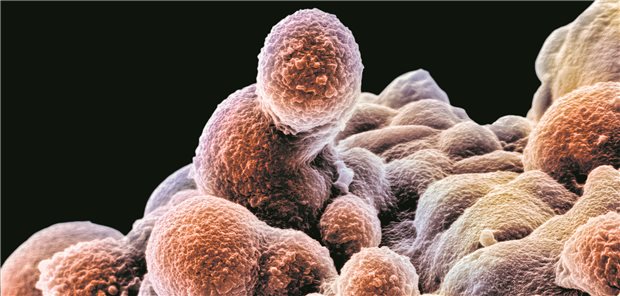 Prostatakarzinomzellen können mit einer Radioligandentherapie basierend auf dem Marker PSMA gezielt aufgespürt und bestrahlt werden.