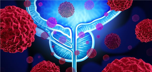 Prostatakrebs: Die externe Radiatio bietet einige Vorteile. Nachteilig ist jedoch, dass sich mit ihr keine etwaigen Lymphknotenmetastasen auffinden lassen.