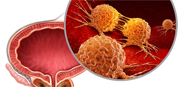 Prostatakrebs: Was ist die beste First-Line-Therapie?
