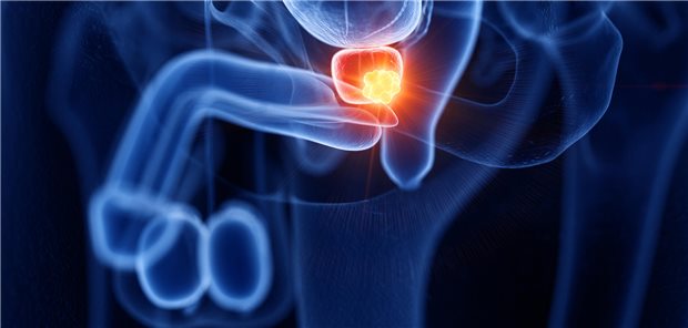 Prostatakrebs: Schematische Darstellung.