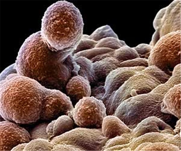 Ist der Prostatakrebs bei Männern über 75 aggressiver? Prostatakrebs wird bei alten Männern oft erst in späten Stadien erkannt. Das spricht für Mängel beim Screening.