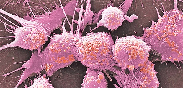 Die Zweitmeinung funktioniert Prostatakrebszellen: Die PREFERE-Studie soll beantworten, welche Therapie bei begrenztem Prostata-Ca besser geeignet ist: Radikale Prostatektomie, perkutane Strahlentherapie, Brachytherapie oder Active Surveillance.