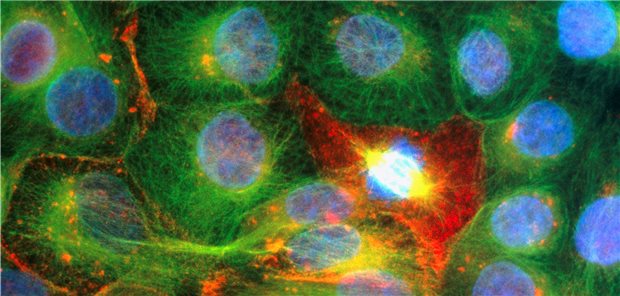 Prostatatumorzelle: ein neuer Therapieansatz soll es erleichtern, erfolgreich die Apoptose zu provozieren.