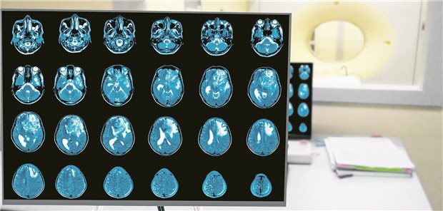 Protonenpumpeninhibitoren könnten die Prognose von Patienten mit Glioblastomen verschlechtern. Schweizer Forschende sprechen sich dafür aus, die Substanzen hier nicht einzusetzen.