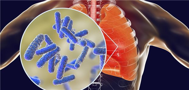 Pseudomonas aeruginosa in der Lunge: Durch inhalative Kortikosteroide induzierte Veränderungen des Immunsystems
erhöhen die bakterielle Belastung der Atemwege.