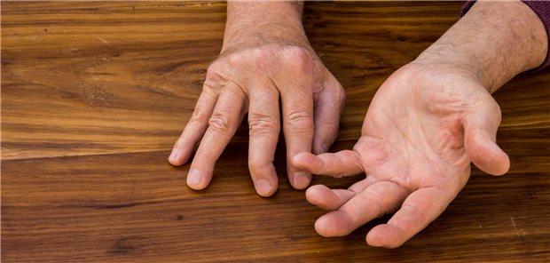 Psoriasis-Arthritis: Geschwollene Gelenke, permanenter Knochenschaden und deformierte Finger.