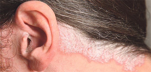 Schuppen und Jucken im Griff Psoriasis: Bei schwerer Erkrankung profitieren Betroffene von einer Therapie mit Biologika.