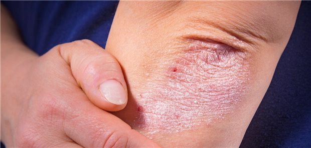 Psoriasis-Patienten nach wie vor stigmatisiert Psoriasis: Betroffene sehen sich mit Vorurteilen konfrontiert.