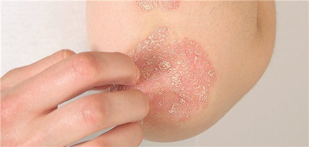 Psoriasis: Da beeinflussen sich Haut und Psyche gegenseitig. Die neuroimmunologischen Zusammenhänge werden zunehmend verstanden.