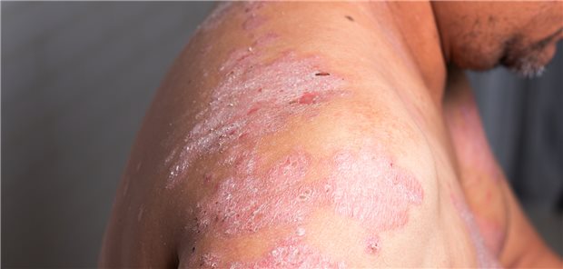 Psoriasis: Die Liste prominenter Künstlerinnen und Künstler oder Persönlichkeiten der Zeitgeschichte, die an Psoriasis vulgaris gelitten haben (sollen), ist lang.