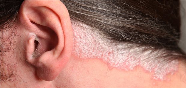 Psoriasis: Die Versorgung von Patienten mit Psoriasis in Deutschland hat sich einer Studie zufolge gebessert.