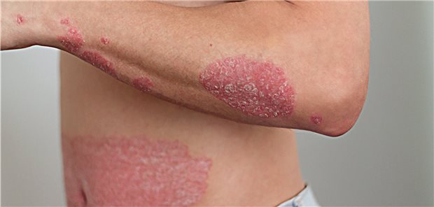 Psoriasis: Etwa jeder fünfte Patient. hat eine mittelschwere bis schwere Form. 