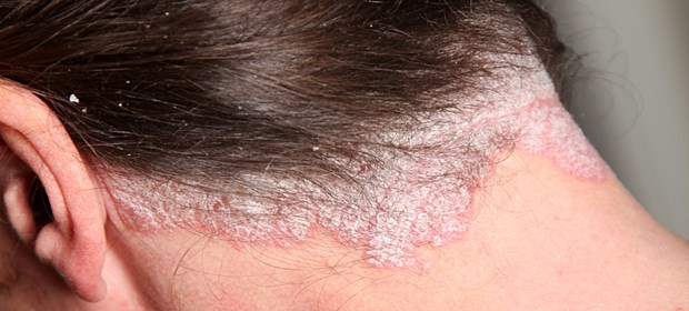 Schuppenflechte geht unter die Haut Psoriasis: Nur auf den ersten Blick eine reine Hautkrankheit.