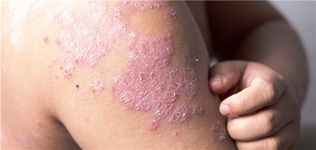 Temedica baut mit Bristol Myers Squibb an Psoriasis-App Psoriasis-Patienten haben einen hohen Leidensdruck.
