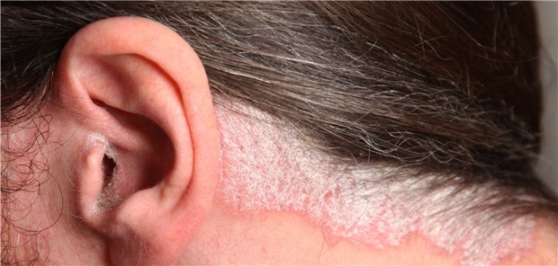 Psoriasis: Patienten mit schweren Verläufen müssen zum Teil weite Wege in Kauf nehmen. 