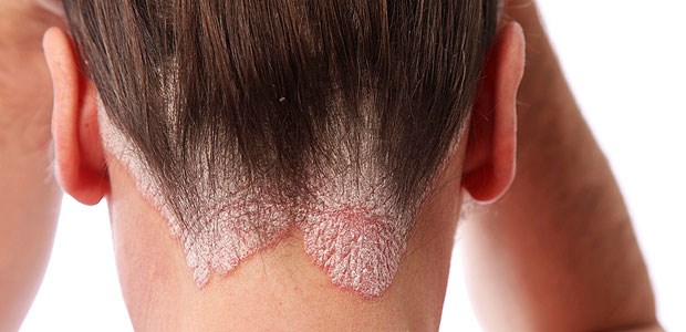 Schuppenflechte ist nicht nur eine Hauterkrankung Psoriasis am Haaransatz – nicht immer erhalten Betroffene die optimale Therapie. Heute, am Welt-Psoriasis-Tag, wird auf dieses Defizit aufmerksam gemacht.