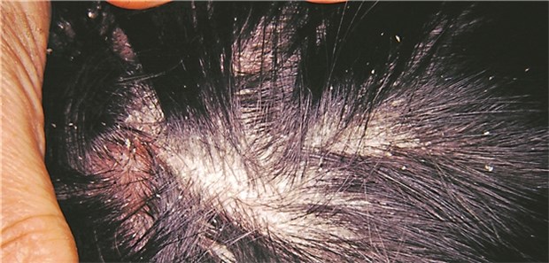 Psoriasis-Arthritis bleibt oft unerkannt Psoriasis des behaarten Kopfes: Die betroffenen Patienten haben häufig auch eine Psoriasis-Arthritis.