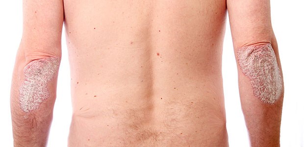 Psoriasis - eine Erkrankung, die sich am Ellenbogen zeigen kann. Sie ist aber auch fürs Herz gefährlich.