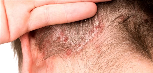 Psoriasis im Haaransatz: Patienten mit chronisch entzündlicher Darmerkrankung haben ein erhöhtes Risiko für die Schuppenflechte.