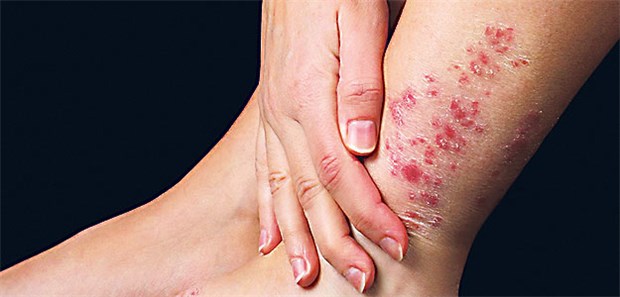 Wie Krieg gegen die eigene Haut "Psoriasis" stammt vom griechischen psao, ich kratze - ein typisches Symptom.
