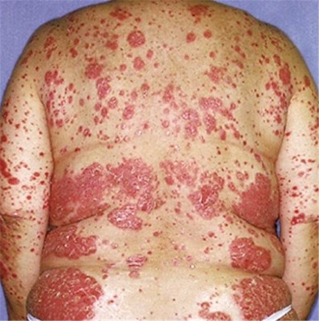 Methotrexat bei Psoriasis plus Übergewicht heißt: Lebertests Psoriasis und Übergewicht - bei dieser Kombination gilt: Vorsicht mit Methotrexat.