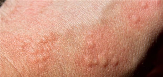Quaddeln auf der Haut: Unter den zugelassenen Wirkstoffen haben sich bei chronischer spontaner Urtikaria Omalizumab und Cyclosporin in einer Metaanalyse als die wirksamsten Alternativen zu Antihistaminika herausgestellt.