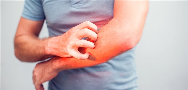 Quälender Juckreiz: Was ist die Ursache? Eine Hauterkrankung, eine Medikamentennebenwirkung, eine internistische, neurologische oder psychiatrische Ursache?
