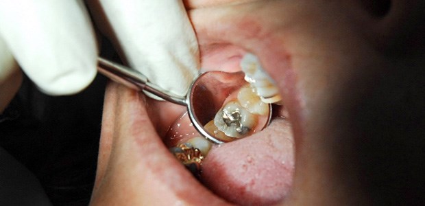 Sparen Zahnärzte beim Amalgam? Quecksilber im Mund: Laut der Linkspartei bieten Zahnärzte immer seltener Amalgam-Füllungen an.