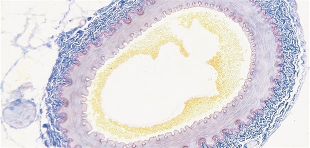 Rauchen verkalkt Arterien stärker als Kiffen Querschnitt einer Arterie mit Verkalkungen (gelb).