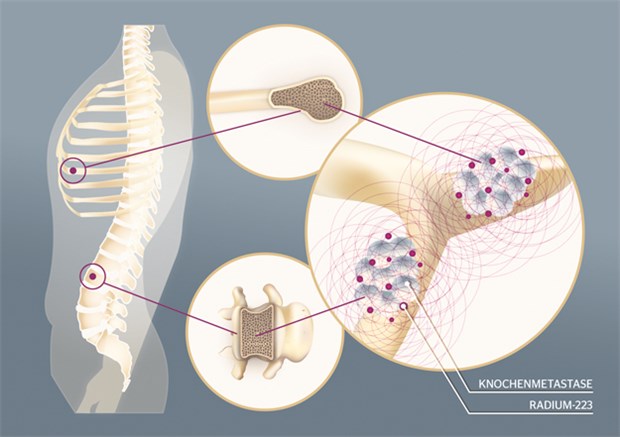 Radium-223 wird in das Hydroxylapatitgitter von Knochenarealen mit erhöhtem Knochenumsatz, z.B. Knochenmetastasen, eingebaut und führt durch die Emission von Alpha-Strahlen zu zytotoxischen Effekten in den Tumorzellen.