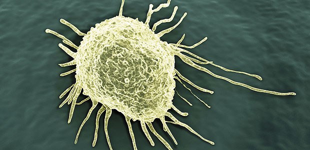 Rasterelektronenmikroskopische Aufnahme einer Krebszelle.